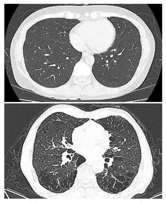 정상인 폐(위)와 만성폐쇄성폐질환 환자의 폐 전산화단층활영.