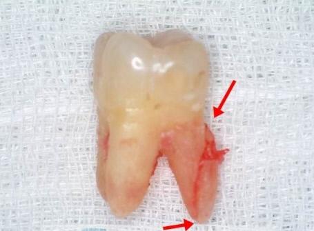치아 뿌리까지 진행된 치아 균열 모습.
