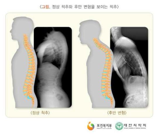 정상 척추와 후만 변형을 보이는 척추. 사진=손정형외과 제공
