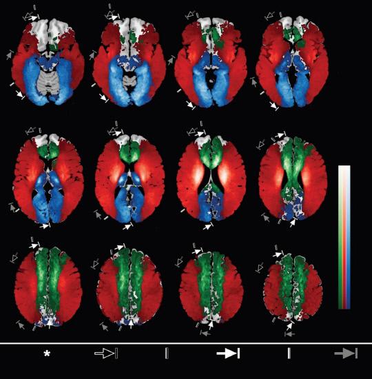 특정 대뇌혈관이 막혔을 때 뇌의 어떤 부위에 뇌경색이 생기는지 조각별로 역학적인 확률을 제공하는 빅데이터 기반 뇌지도. 빨간색-중대뇌동맥 / 녹색-전대뇌동맥 / 파란색-후대뇌동맥)
사진=KRISS 제공
