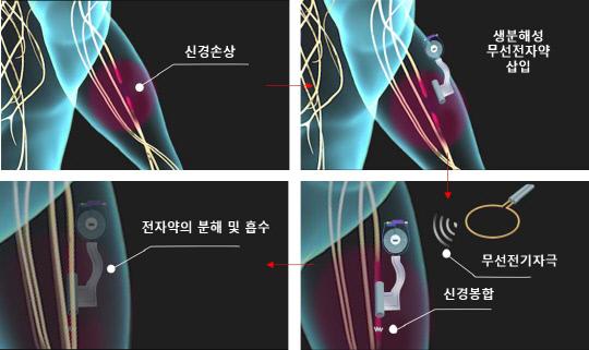 생분해성 전자약의 신경치료 시나리오 모식도. 사진=한국과학기술원 제공
