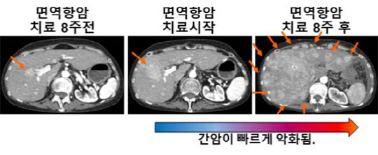 면역 항암 치료 뒤 간암 급성 진행을 보여주는 간암 환자의 CT. 사진=한국연구재단 제공
