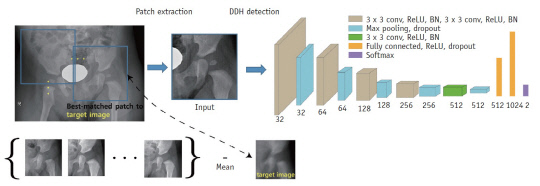 연구진이 개발한 소아 고관절 이형성증(DDH) 검출 방법. 사진=국가수리과학연구소 제공 
